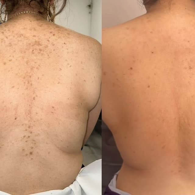 OrganoPeel Back Treatment Packages at Batool’s Esthetics in Rocklin, CA
